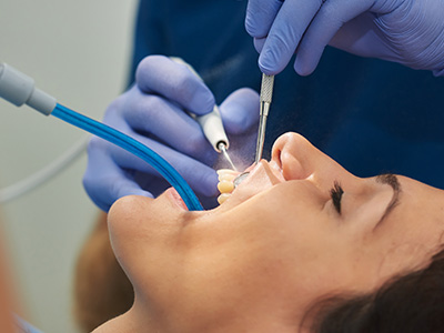 Frankford Dental Group | Root Canals, Oral Exams and Deep Cleanings