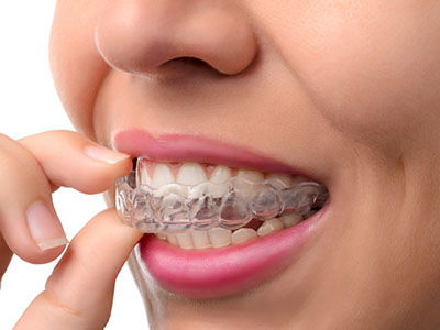 Frankford Dental Group | Dental Sealants, Extractions and Emergency Treatment